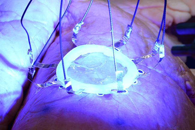 3D printing of sensor on lung