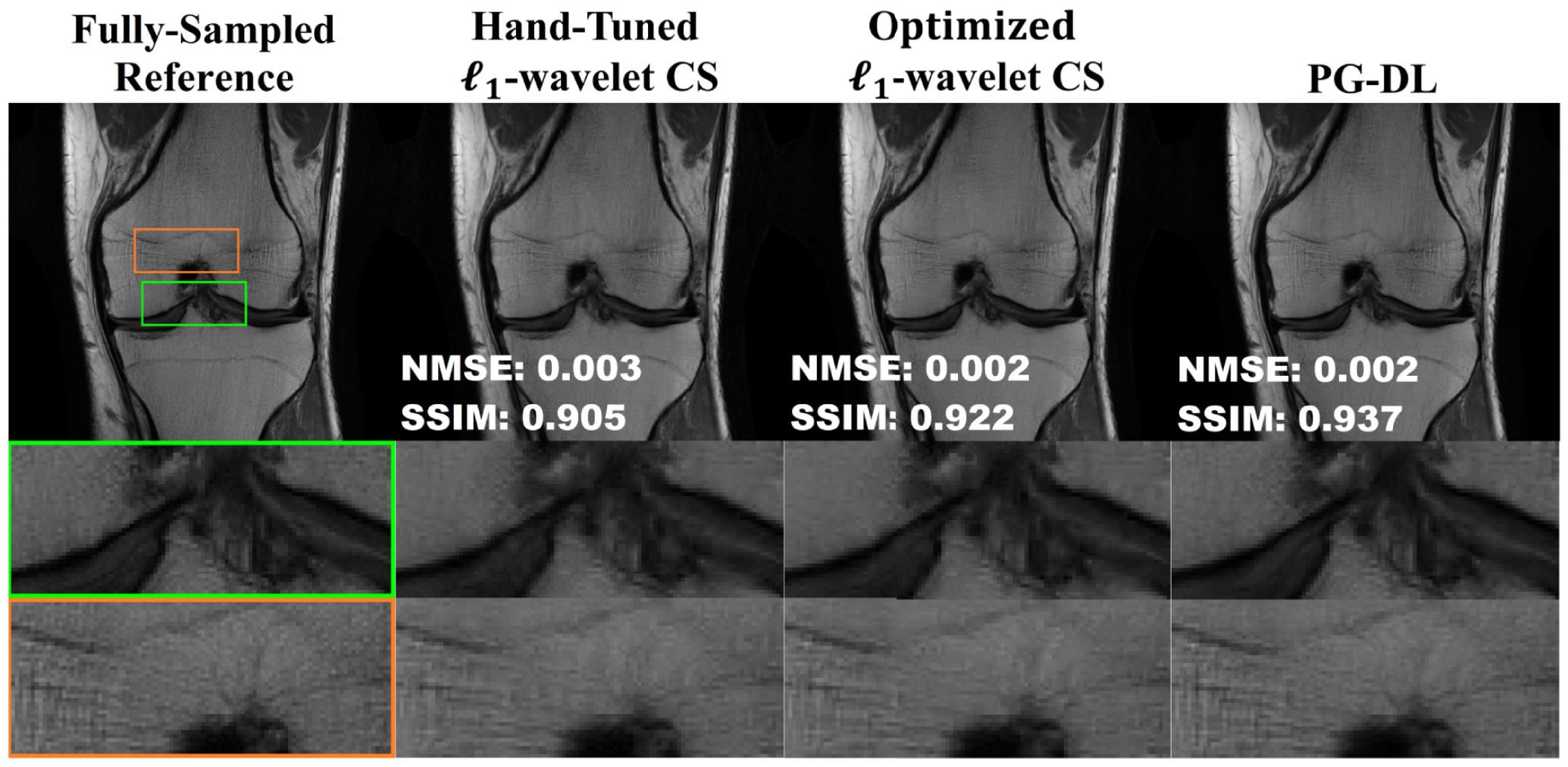MRI image of knee