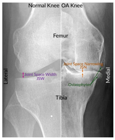 An instance of X-ray images of the normal knee and severe OA knee.