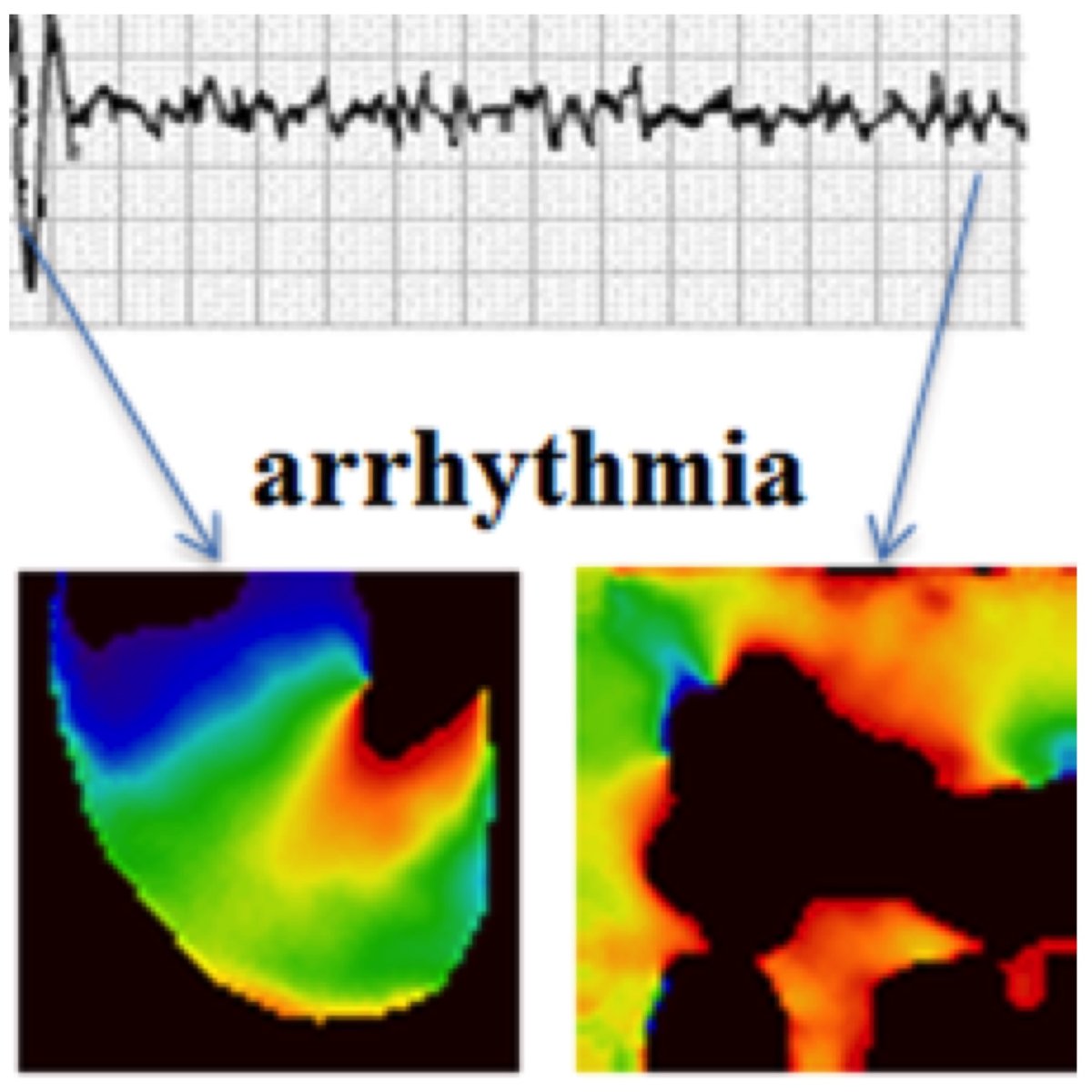 Text says "arrhythmia", with three images. Graph above showing reduction in heart rhythm variation. Colorful VT and VF scans below showing what heart looks like at that time.
