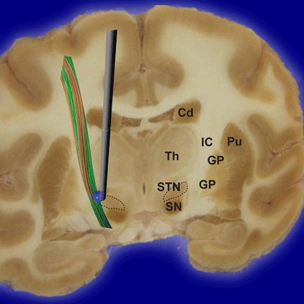 Graphic of the brain and a few of its parts, indicating Cd, Th, IC, GP, Pu, SN and STN.