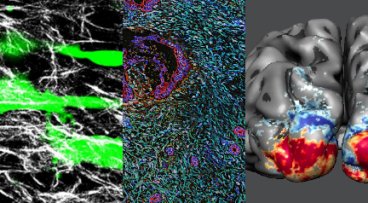 Collage showing cancer cells, imaging scan, and brain rendering