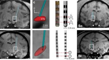 Biomedical images showing that knowing the spatial position and orientation of each electrode in the context of the targeted nucleus or fiber pathways could help guide how deep brain stimulation systems are programmed.