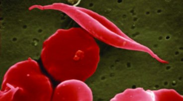 Sickle cell and regular red blood cells