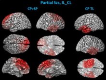 multiple cat scans of a brain showing partial seizures