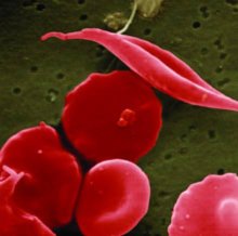 Red blood cells that indicate sickle cell disease