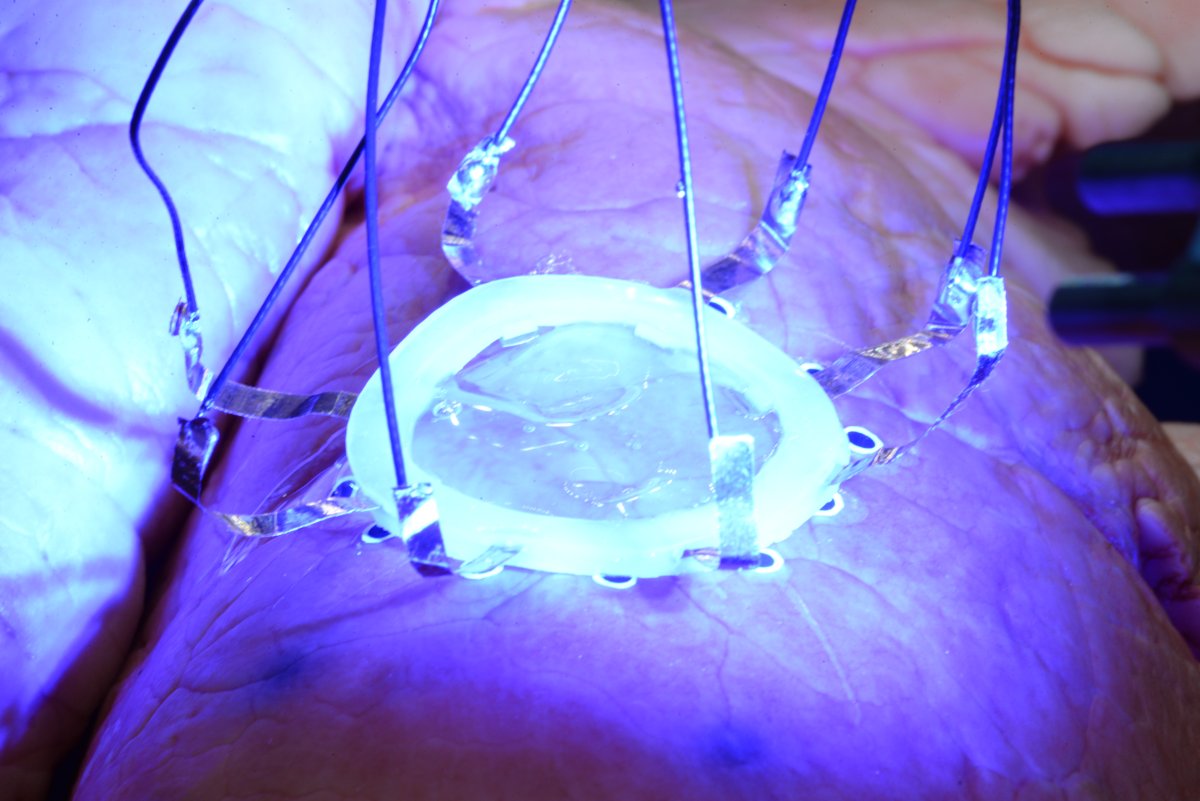 3D Printing a sensor on lungs