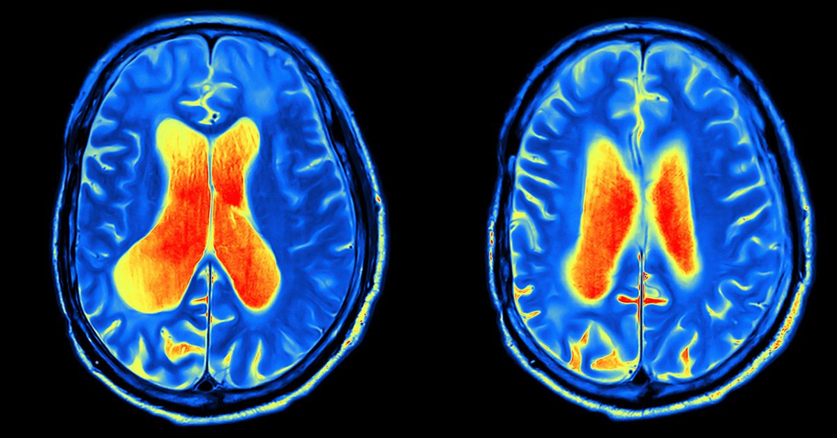 Two brain MRI scans