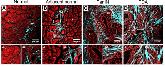 Advanced nonlinear imaging of patient samples showing tissue architecture by autofluorescence and fibrous collagen by second harmonic generation in (A) normal, (B) cancer-adjacent “normal” tissue, (C) “pre-invasive” disease (e.g., pancreatic intraepithelial neoplasia), and (D) mature pancreatic ductal adenocarcinoma (# and ##, 2× magnifications of the indicated regions).