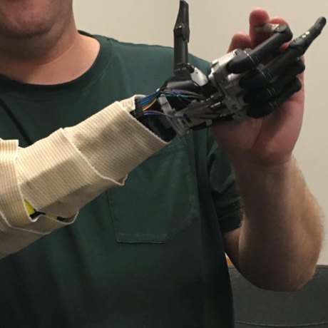 Man with a robotic arm